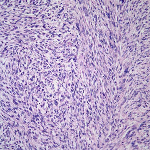 Findings from a secondary data analysis suggest a need for further research to determine risk factors that place younger patients who are Puerto Rican at a high risk of endometrial cancer. 