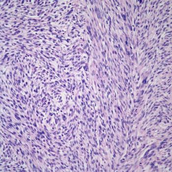 Findings from a secondary data analysis suggest a need for further research to determine risk factors that place younger patients who are Puerto Rican at a high risk of endometrial cancer.