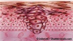 Targeting the Tumor Microenvironment May Aid in Treatment of Ovarian Cancer