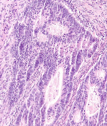 Investigators will assess botensilimab and balstilimab for non-microsatellite instability-high/mismatch repair deficient metastatic colorectal cancer in a randomized phase 2 trial.