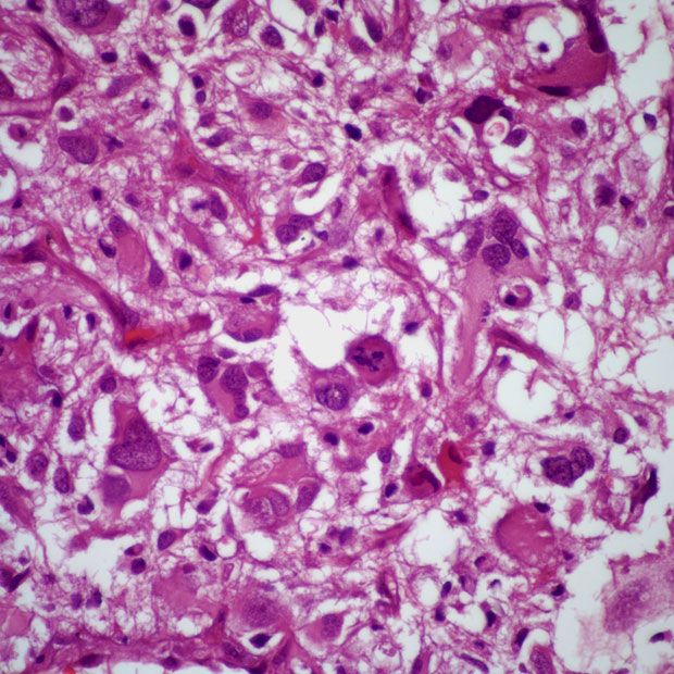Investigators are assessing tirabrutinib, which received orphan drug designation from the FDA, as a treatment for patients with relapsed or refractory primary central nervous system lymphoma in the phase 2 PROSPECT study. 