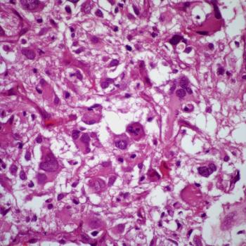 Investigators are assessing tirabrutinib, which received orphan drug designation from the FDA, as a treatment for patients with relapsed or refractory primary central nervous system lymphoma in the phase 2 PROSPECT study. 