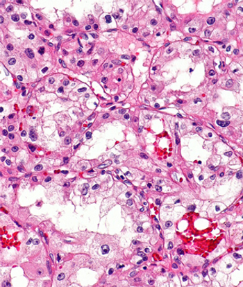 Progression-free survival and overall survival appear to be worse in patients with metastatic colorectal cancer who have a high- vs low-BRAF allele fraction after treatment with a BRAF inhibitor plus an anti-EGFR agent plus or minus a MEK inhibitor.