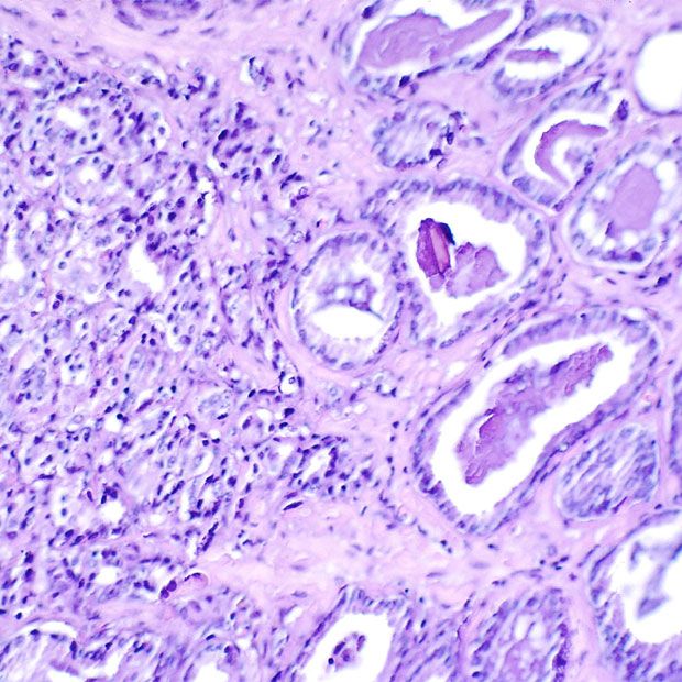 Histological slide showing Gleason 7 prostate cancer 
