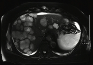 A Rare Case of Glioblastoma With Extensive Liver Metastases