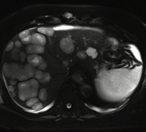 A Rare Case of Glioblastoma With Extensive Liver Metastases