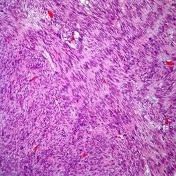 CHM 2101 will be assessed as part of a phase 1A/B clinical study in a population of patients diagnosed with advanced colorectal cancer, gastric cancer, and neuroendocrine cancer.