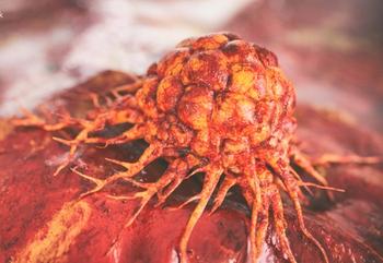 Among the 12 patients with suspected brain metastases treated with RAD 101, the images showed metabolic activity in brain metastases compared with MRI findings. 