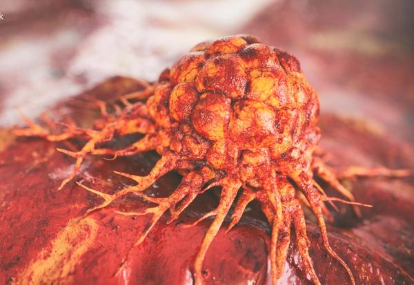 Among the 12 patients with suspected brain metastases treated with RAD 101, the images showed metabolic activity in brain metastases compared with MRI findings. 