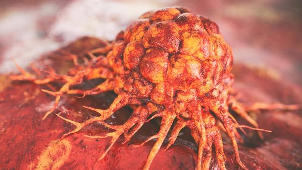 Among the 12 patients with suspected brain metastases treated with RAD 101, the images showed metabolic activity in brain metastases compared with MRI findings.