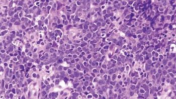 DLBCL
