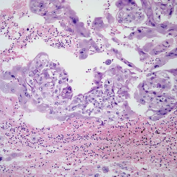 Investigators report that loss of MMR mechanism is not predictive of response to chemotherapy or pembrolizumab in patients with stage III or IVA, stage IVB, or recurrent endometrial cancer.