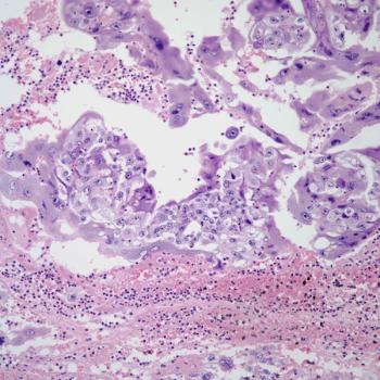 Investigators report that loss of MMR mechanism is not predictive of response to chemotherapy or pembrolizumab in patients with stage III or IVA, stage IVB, or recurrent endometrial cancer.