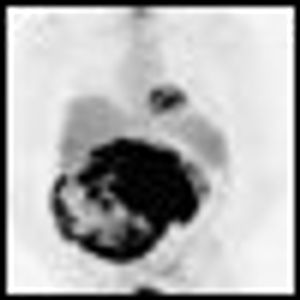 Imatinib Mesylate: A Molecularly Targeted Therapy for Gastrointestinal Stromal Tumors