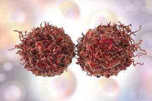 Experts Develop New Guideline for Advanced Prostate Cancer