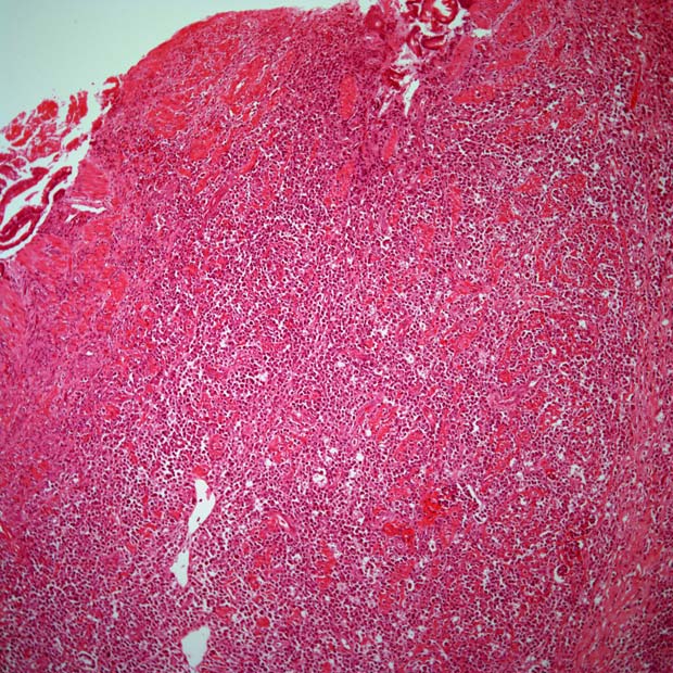 The addition of stereotactic radiotherapy to immune checkpoint inhibition appears safe but yields no significant survival benefit among patients with advanced solid tumors.