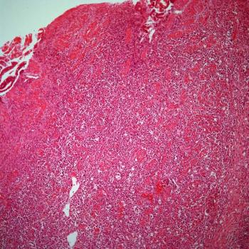 The addition of stereotactic radiotherapy to immune checkpoint inhibition appears safe but yields no significant survival benefit among patients with advanced solid tumors.