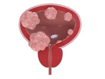 Adverse reactions in the phase 3 ENVISION trial were largely mild to moderate in severity, and serious reactions occurred in 12% of those with NMIBC.