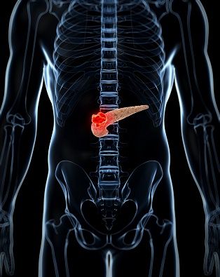 Post hoc analysis of the phase 3 NAPOLI 3 trial assessed how dose reductions in liposomal irinotecan/oxaliplatin affect OS in NALIRIFOX-treated PDAC.