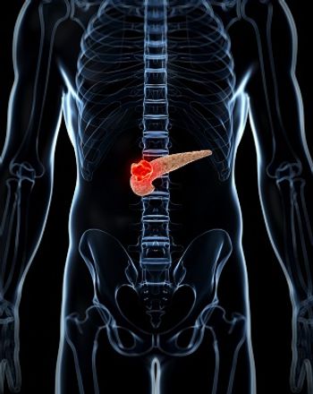 Post hoc analysis of the phase 3 NAPOLI 3 trial assessed how dose reductions in liposomal irinotecan/oxaliplatin affect OS in NALIRIFOX-treated PDAC.
