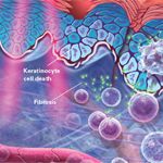 Radiation Dermatitis: Recognition, Prevention, and Management