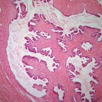 Even when adjusting for prior taxane responses in patients with ovarian cancer, ixabepilone/bevacizumab appears to yield survival benefits in a phase 2 trial.