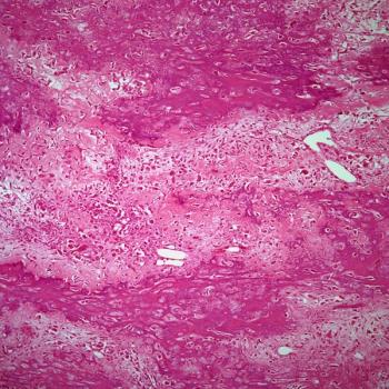 The phase 3 INVINCIBLE-3 trial is evaluating INT230-6 vs standard of care in locally recurrent, inoperable, or metastatic soft tissue sarcoma.