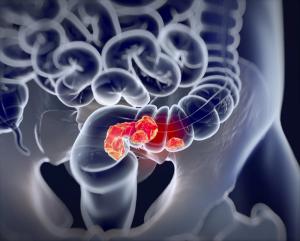 Unnecessary Use of Antibiotics May Lead to Early Onset CRC in Patients Under 50 Years