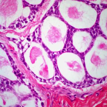 Certain patients with salivary gland carcinoma and close surgical margins may safely be considered for observation, according to findings from a retrospective cohort study.