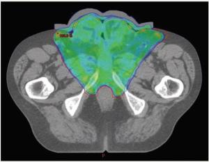 Advanced Penile Cancer Presenting With Renal Failure