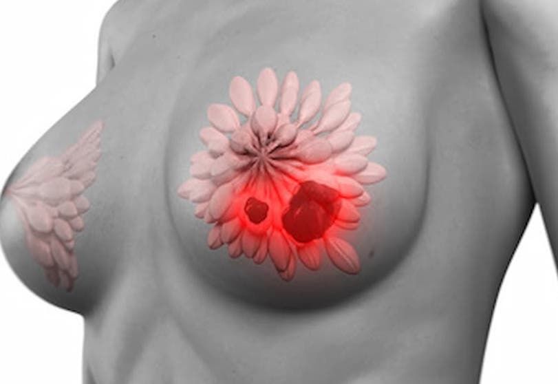 La transferencia de enfermeras produce una reducción de la angustia inadvertida en el cáncer de mama