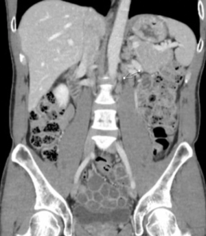 Evaluation and Management of Testicular Cancer After Late Relapse