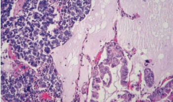 Cabozantinib may become a new treatment option for those with previously treated advanced neuroendocrine tumors based on data from the phase 3 CABINET trial.