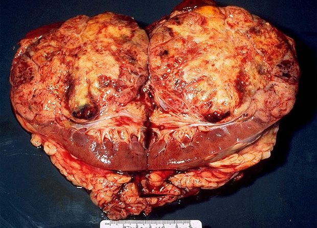Gross pathology of bisected kidney showing large RCC