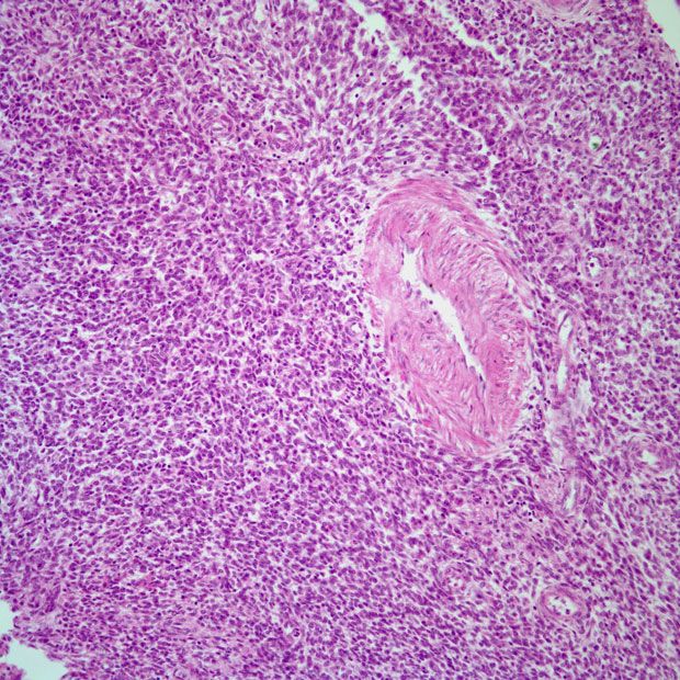 In the SOLAR phase 1b trial, a clinical benefit was observed when patients with RAS-mutated ovarian or endometrial cancer were given olaparib plus selumetinib.