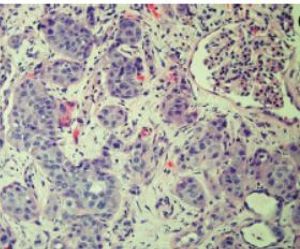 Incidental Primary Squamous Cell Carcinoma of the Kidney Within a Calyceal Diverticulum Associated With Nephrolithiasis