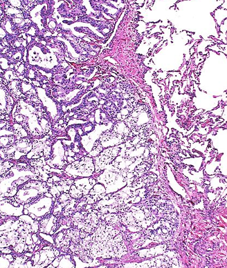 Data from the phase 3 MAGNITUDE study support the European Commission’s approval of niraparib plus abiraterone acetate dual action tablets in BRCA-mutated metastatic castration-resistant prostate cancer.