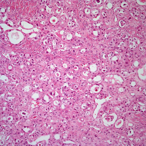 The efficacy of HIPEC plus cytoreductive surgery appears to be consistent across ovarian cancer subgroups based on age, histological type, and pre-surgery laparoscopy in the phase 3 OVHIPEC-1 trial.