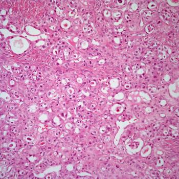 Data from the phase 3 PRIME trial show improved survival outcomes with frontline niraparib maintenance therapy among patients with advanced ovarian cancer.