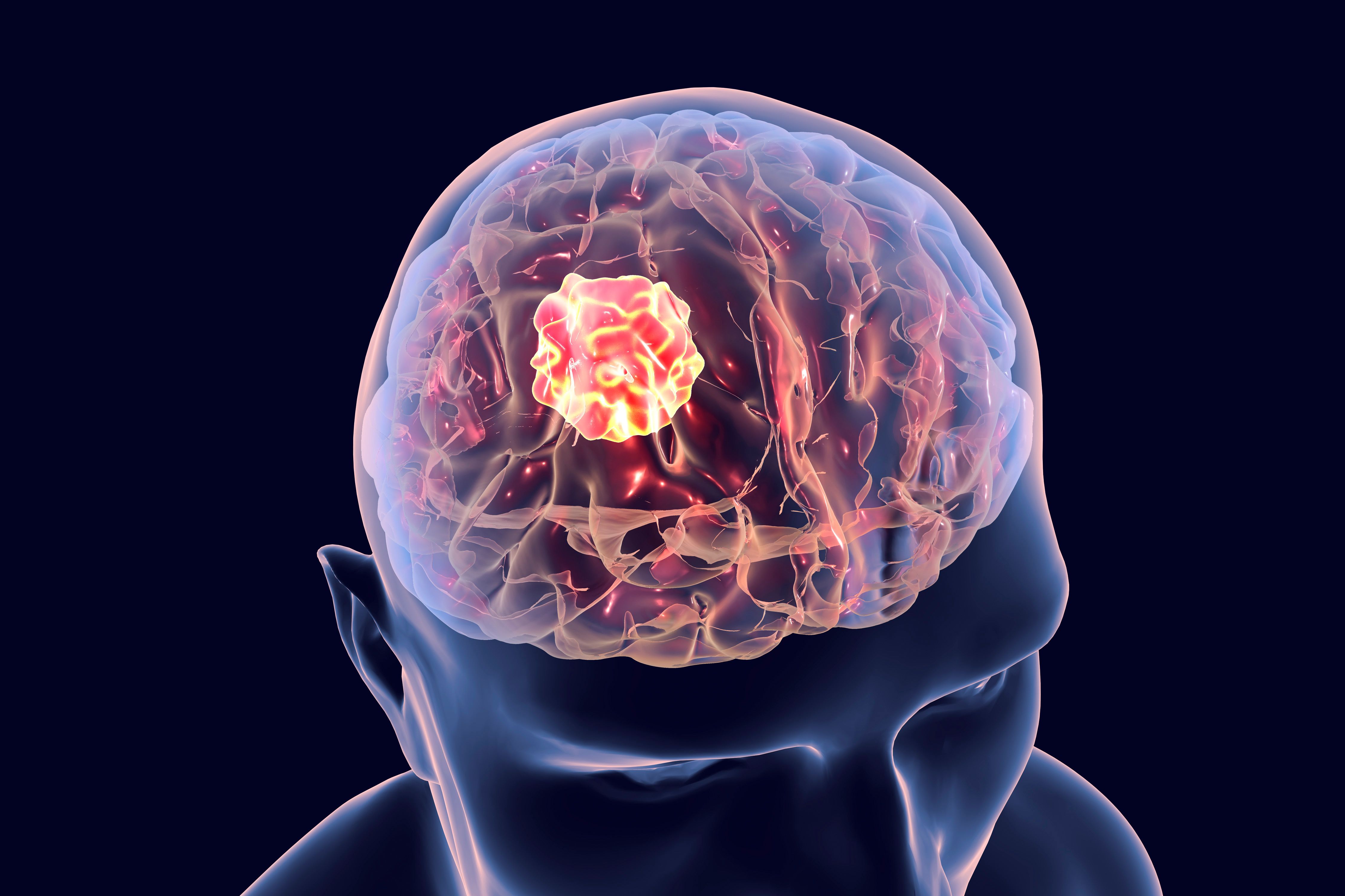 Brain cancer, 3D illustration showing presence of tumor inside brain: © Dr_Microbe - stock.adobe.com