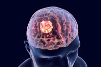 Brain cancer, 3D illustration showing presence of tumor inside brain: © Dr_Microbe - stock.adobe.com