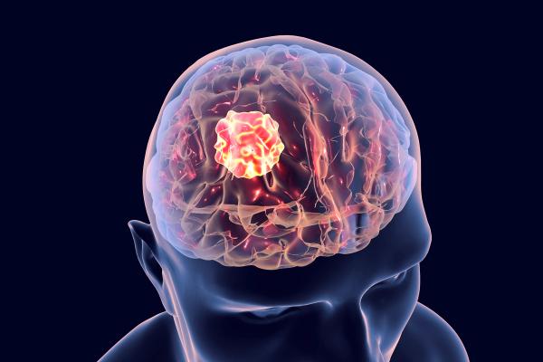 Brain cancer, 3D illustration showing presence of tumor inside brain: © Dr_Microbe - stock.adobe.com