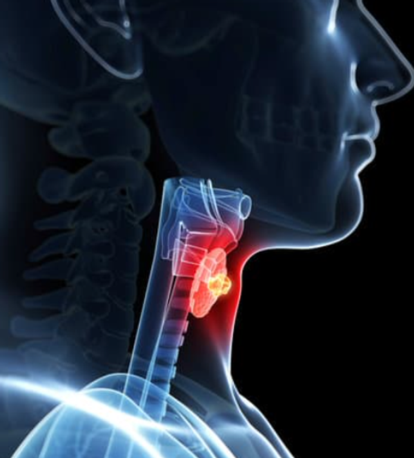 Evaluating Thyroid Cancer Risk After GLP-1 Receptor Agonist Administration