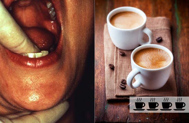 Coffee and head and neck cancer risk