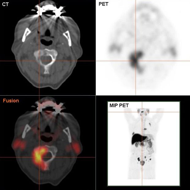 F-18 choline PET/CT scan showing bone metastasis of prostate cancer