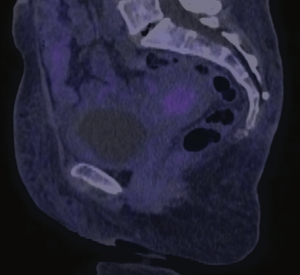 Treatment of Locally Advanced Cervical Cancer With Kidney Failure and Comorbidities
