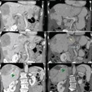 Pancreatic Neuroendocrine Tumors: State-of-the-Art Diagnosis and Management