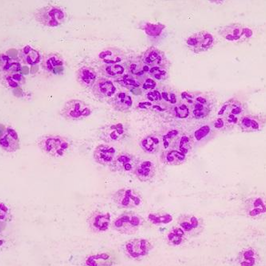 AI Can Predict Sepsis to Save Lives