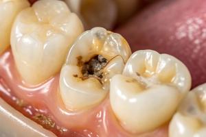 LC-MS/MS Tests Saliva Endocannabinoids, Cavities