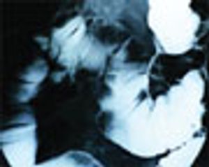 A Chromatographic Screening Method to Identify Agents that Reverse Intrinsic Drug Resistance in Colon Cancer Cells